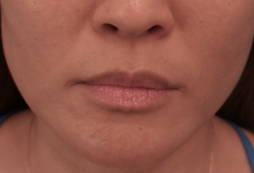 Lip Filler Patient #10 Before Photo # 1