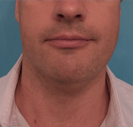 Male Kybella Patient #7 Before Photo # 1