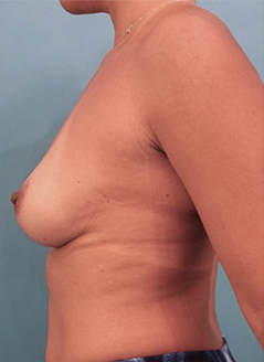 Breast Augmentation (Implants) Patient #5 Before Photo # 5