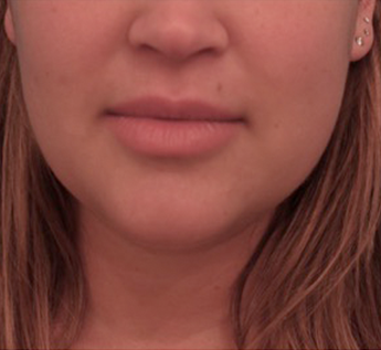 Kybella Patient #14 After Photo Thumbnail # 2