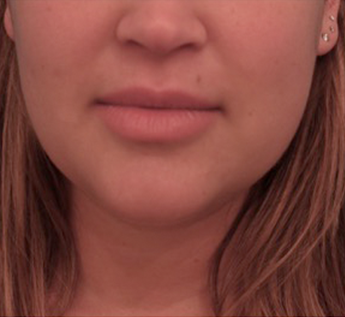 Kybella Patient #14 After Photo # 2