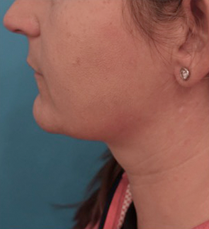 Kybella Patient #13 Before Photo # 7