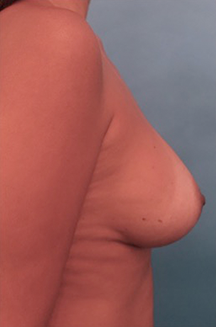 Breast Augmentation (Implants) Patient #5 After Photo # 10
