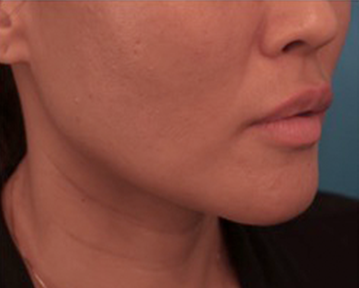 Lip Filler Patient #10 After Photo # 4