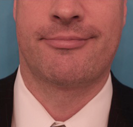 After Image: Kybella Patient #11 - 