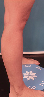 After Image: Liposuction Patient #12 -