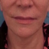 Kybella Patient