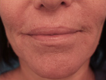 Lip Filler Patient #12 After Photo Thumbnail # 2