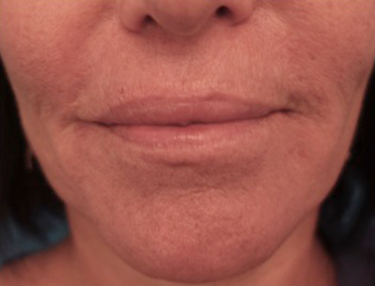 Lip Filler Patient #12 After Photo # 2