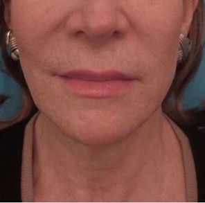 Dermal Fillers (Facial Contouring) Patient #4 After Photo # 2