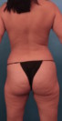 Brazilian Butt Lift Patient #2 Before Photo Thumbnail # 3