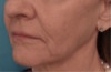 Dermal Fillers (Facial Contouring) Patient #5 Before Photo Thumbnail # 3