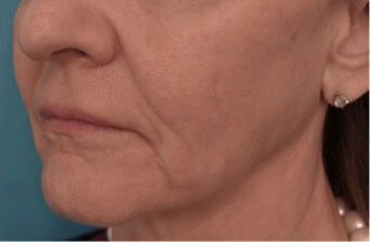 Dermal Fillers (Facial Contouring) Patient #5 Before Photo # 3