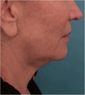 Dermal Fillers (Facial Contouring) Patient #4 Before Photo # 3