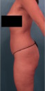 Brazilian Butt Lift Patient #2 Before Photo Thumbnail # 1