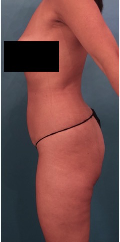 Brazilian Butt Lift Patient #2 Before Photo # 1