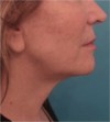 Dermal Fillers (Facial Contouring) Patient #4 After Photo Thumbnail # 4