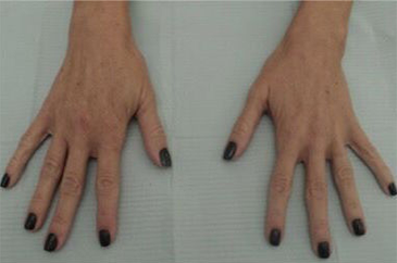 Dermal Fillers (Hand) Patient