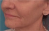 Dermal Fillers (Facial Contouring) Patient #5 After Photo Thumbnail # 4