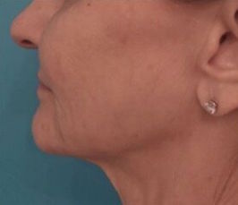 Dermal Fillers (Facial Contouring) Patient #5 After Photo # 6