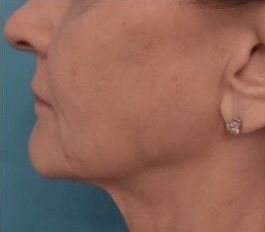 Dermal Fillers (Facial Contouring) Patient #5 Before Photo # 5