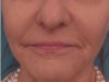 Dermal Fillers (Facial Contouring) Patient