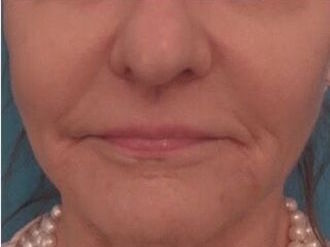 Dermal Fillers (Facial Contouring) Patient #5 After Photo # 2