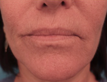 Lip Filler Patient #12 Before Photo # 1