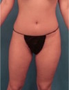 Brazilian Butt Lift Patient #1 Before Photo Thumbnail # 1