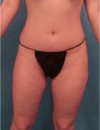 Brazilian Butt Lift Patient