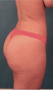 Brazilian Butt Lift Patient #1 After Photo # 14