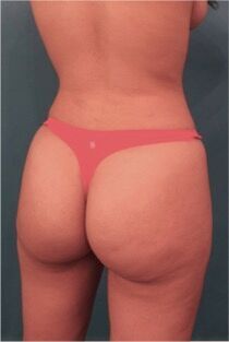 Brazilian Butt Lift Patient #1 After Photo # 12