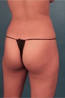 Brazilian Butt Lift Patient #1 Before Photo # 11