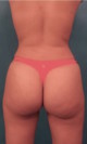 Brazilian Butt Lift Patient #1 After Photo Thumbnail # 10