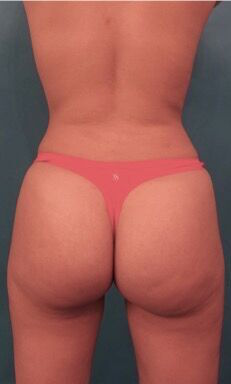 Brazilian Butt Lift Patient #1 After Photo # 10