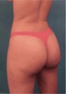 Brazilian Butt Lift Patient #1 After Photo Thumbnail # 8