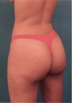 Brazilian Butt Lift Patient #1 After Photo # 8