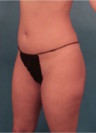 Brazilian Butt Lift Patient #1 Before Photo Thumbnail # 3