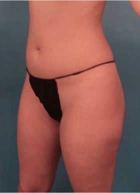 Brazilian Butt Lift Patient #1 Before Photo # 3