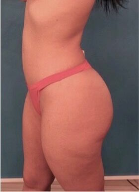 Brazilian Butt Lift Patient #1 After Photo # 4