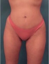Brazilian Butt Lift Patient #1 After Photo Thumbnail # 2
