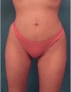 Brazilian Butt Lift Patient