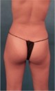 Brazilian Butt Lift Patient #1 Before Photo Thumbnail # 9