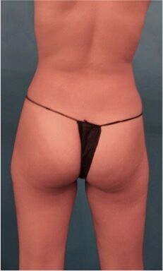 Brazilian Butt Lift Patient #1 Before Photo # 9