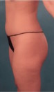 Brazilian Butt Lift Patient #1 Before Photo Thumbnail # 5