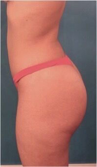 Brazilian Butt Lift Patient #1 After Photo # 6