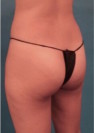 Brazilian Butt Lift Patient #1 Before Photo Thumbnail # 7