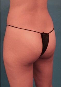 Brazilian Butt Lift Patient #1 Before Photo # 7