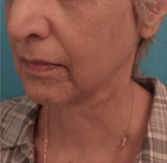 Kybella Patient #6 After Photo Thumbnail # 6