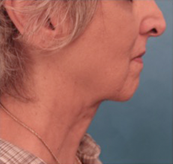 Kybella Patient #6 After Photo Thumbnail # 8